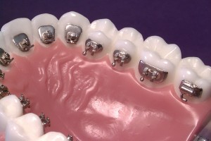 ortodoncia-lingual