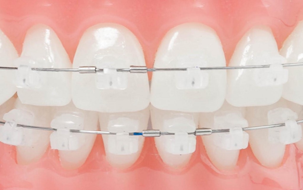 tipos-ortodoncia