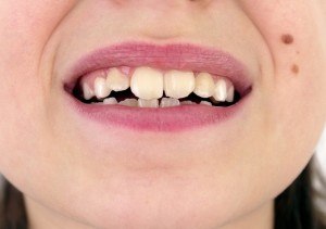 dientes-torcidos